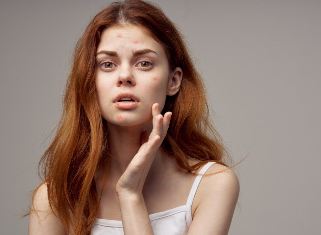 jak pozbyć się trądziku